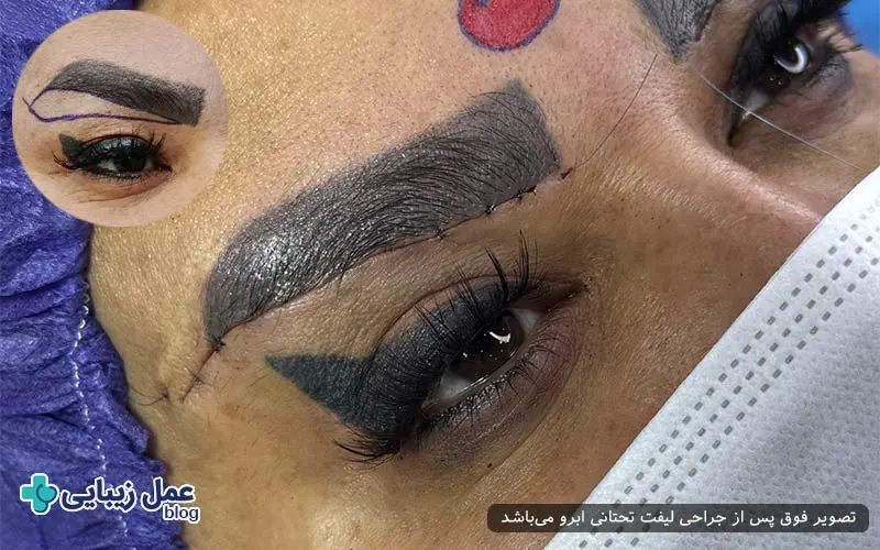 روند مشاهده نتیجه لیفت تحتانی ابرو