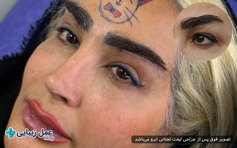 سن به وجود آمدن پف در خانم‌ها