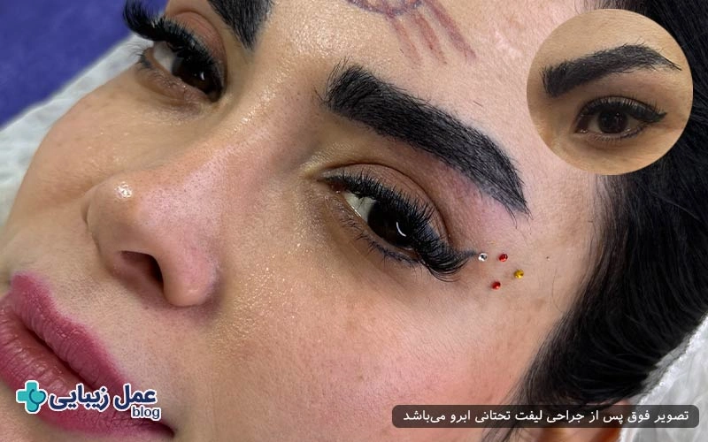 طراحی محل برش در لیفت تحتانی ابرو