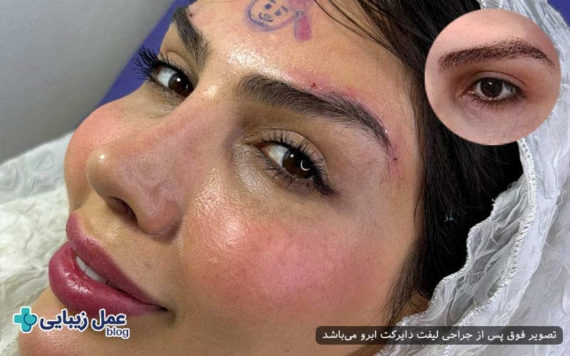 علائم افتادگی ابرو با منشا ژنتیکی