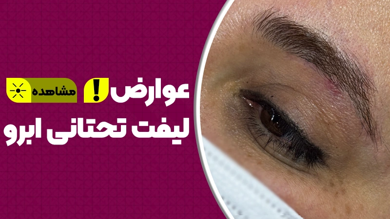 عوارض لیفت تحتانی ابرو