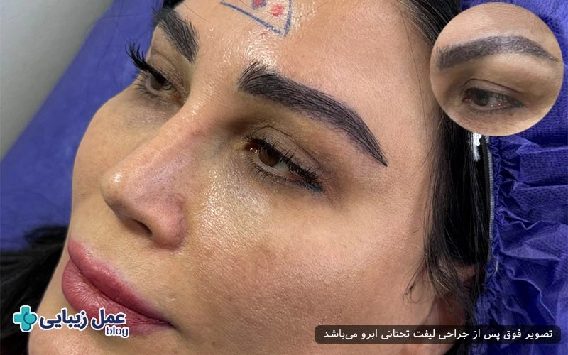 عوامل موثر بر ماندگاری لیفت تحتانی ابرو