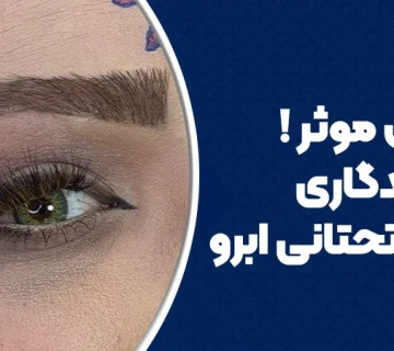 عوامل موثر در ماندگاری لیفت تحتانی ابرو