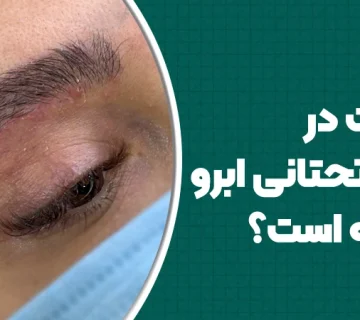 مراقبت در لیفت تحتانی ابرو چگونه است؟