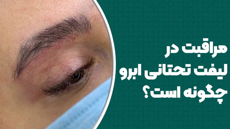 مراقبت در لیفت تحتانی ابرو چگونه است؟