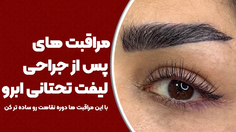 مراقبت‌های پس از جراحی لیفت تحتانی ابرو