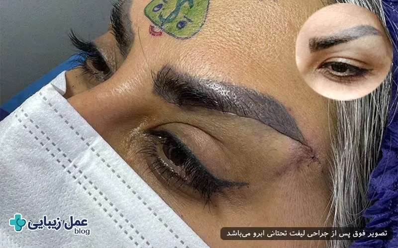 مراقبت‌های قبل از جراحی لیفت تحتانی ابرو
