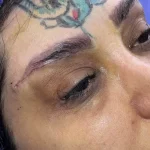 مراقبت‌های قبل از جراحی لیفت تحتانی ابرو