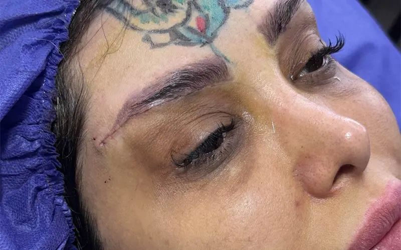 مراقبت‌های قبل از جراحی لیفت تحتانی ابرو