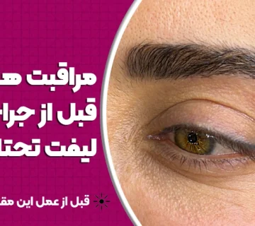 مراقبت‌های قبل از جراحی لیفت تحتانی ابرو