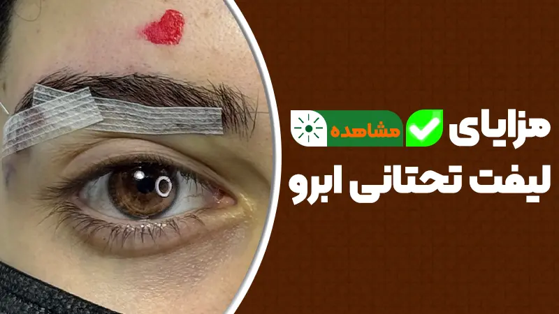مزایای لیفت تحتانی ابرو 1 مزایای لیفت تحتانی ابرو