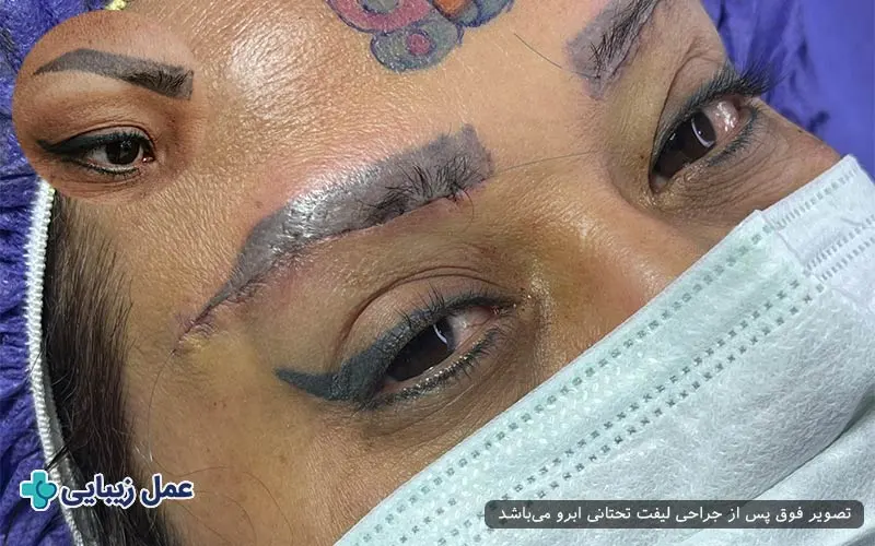 مهم‌ترین دلایل افتادگی ابرو