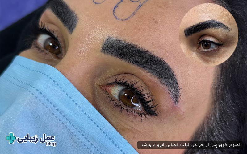 میزان ماندگاری لیفت تحتانی ابرو در خانم‌ها