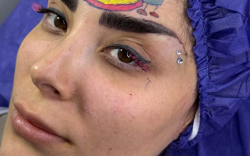 نقش ژنتیک در افتادگی ابرو خانم‌ها