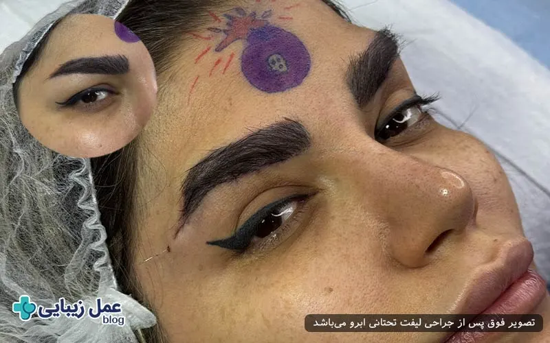 هزینه لیفت تحتانی ابرو