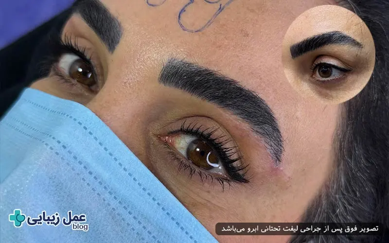 پیری اطراف چشم و دلایل آن