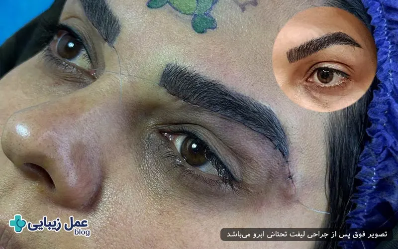 چه چیزهایی در لیفت تحتانی ابرو حذف نمی‌شود؟