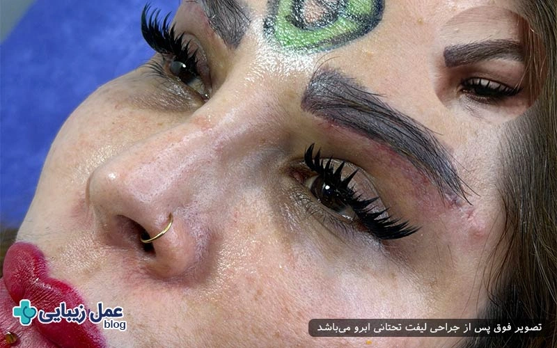 کاندیدهای خانم مناسب لیفت تحتانی ابرو