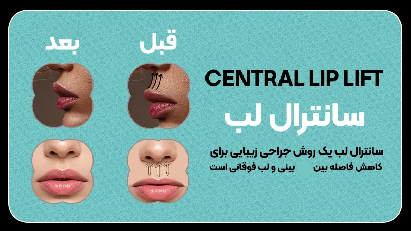 انواع سانترال لب