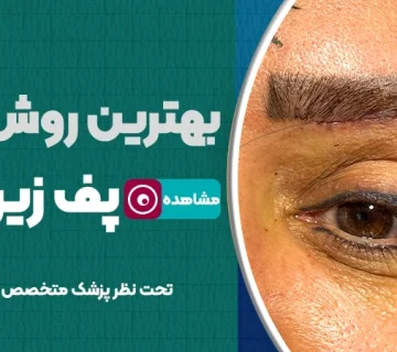 بهترین روش‌ رفع پف زیر ابرو