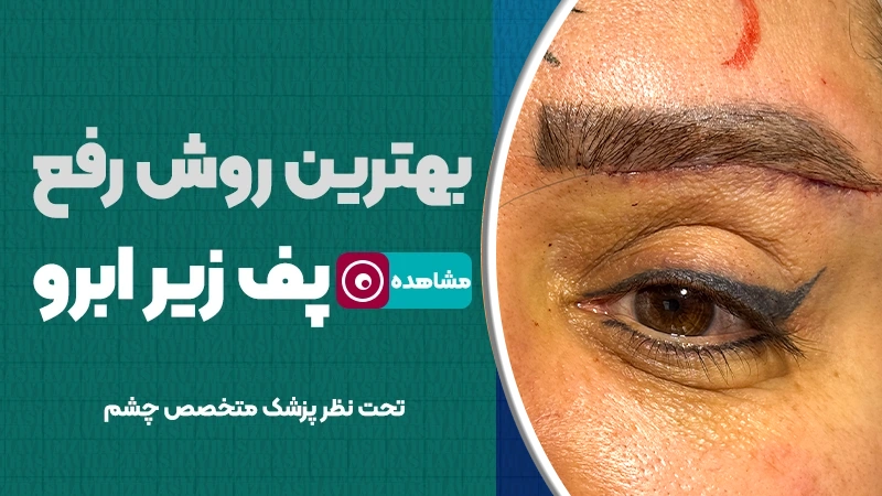 بهترین روش‌ رفع پف زیر ابرو