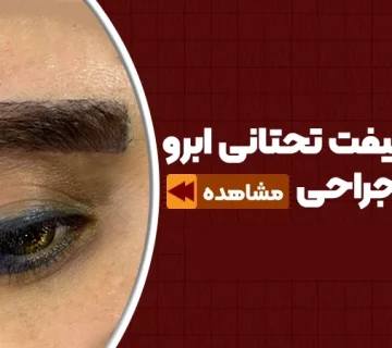 روش لیفت تحتانی ابرو بدون جراحی