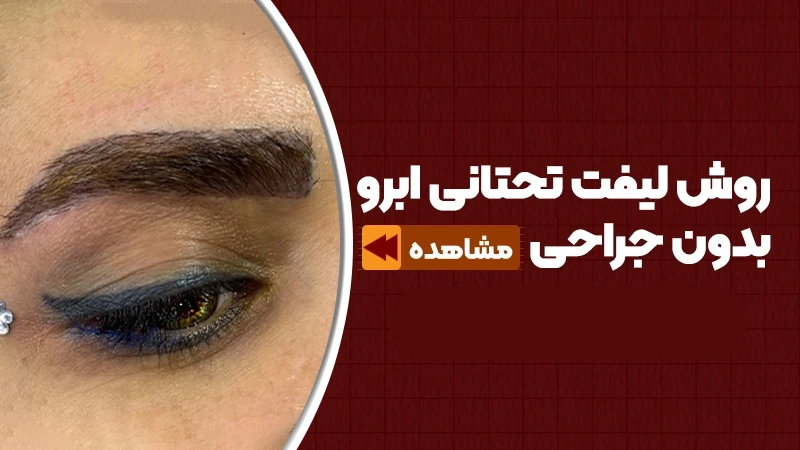 روش لیفت تحتانی ابرو بدون جراحی