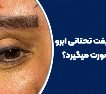 طراحی لیفت تحتانی ابرو چگونه صورت میگیرد
