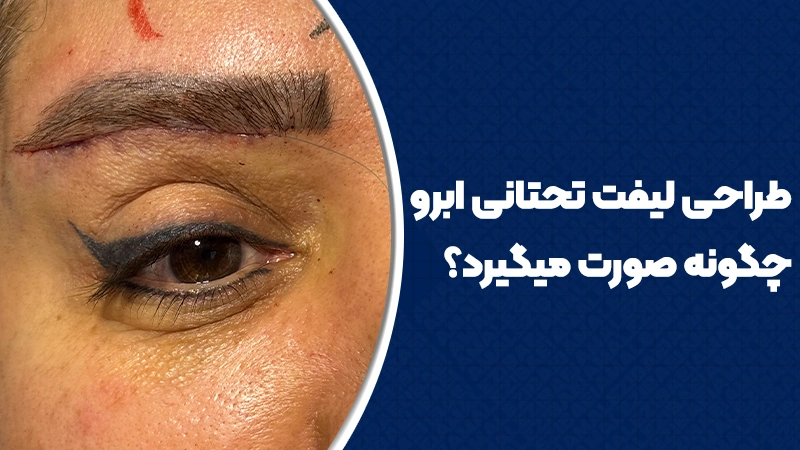 طراحی لیفت تحتانی ابرو چگونه صورت میگیرد
