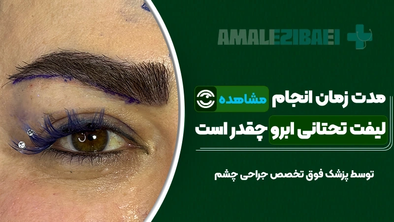 مدت زمان انجام لیفت تحتانی ابرو چقدر است؟