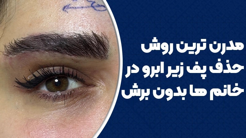 مدرنترین روش حذف پف زیر ابرو در خانمها بدون برش 1 مدرنترین روش حذف پف زیر ابرو در خانمها بدون برش