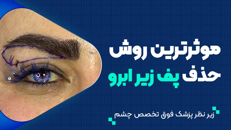 موثرترین روش حذف پف زیر ابرو