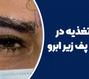 نقش تغذیه در ایجاد پف زیر ابرو