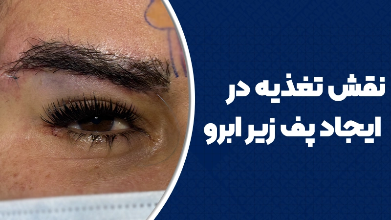 نقش تغذیه در ایجاد پف زیر ابرو 1 نقش تغذیه در ایجاد پف زیر ابرو